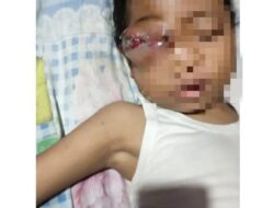 Asyifa Anak Penderita Tumor Mata Butuh Bantuan Pemerintah